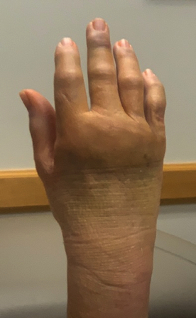 Dec 20 - Two week followup with the hand surgeon. My fingers and knuckles are still a little bruised and swollen. Dec 20 - Two week followup with the hand surgeon. My fingers and knuckles are still a little bruised and swollen.